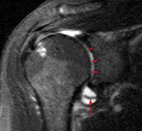 7% incidence <b>of </b>bursal communication was identified in a study using subacromial bursography 6. . Physiologic amount of glenohumeral joint fluid